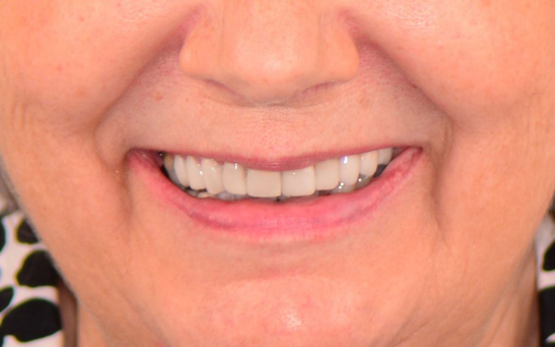A new beginning, antiaging and facial rejuvenation
