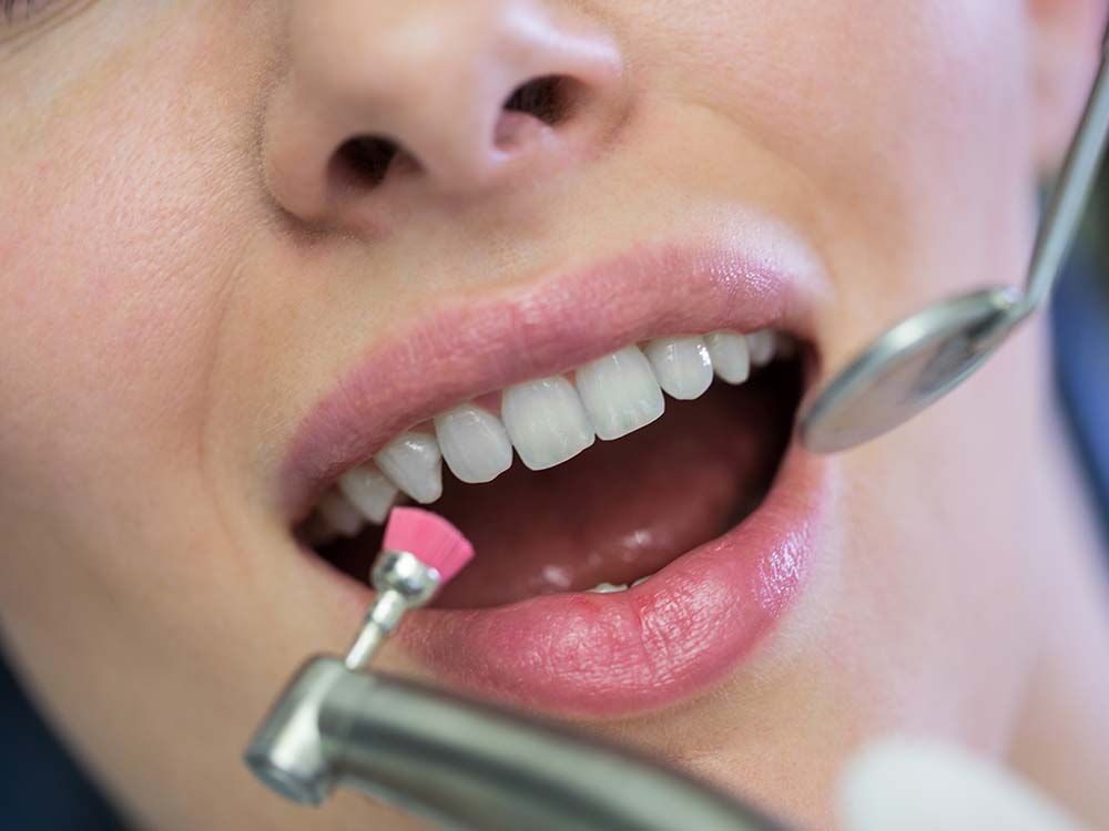 Boca en una limpieza dental