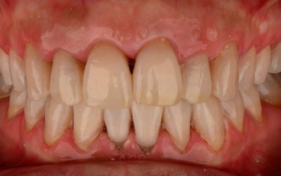 Teeth Whitening with LED light