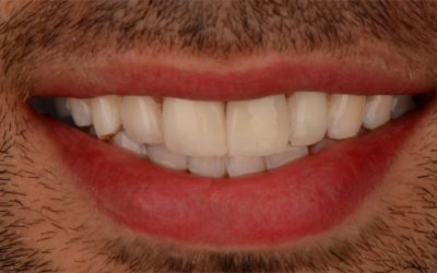 Composite Veneers+Dental Whitening