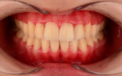 Gum treatment