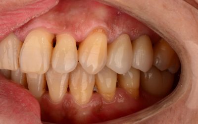 Highly aesthetic zirconium crowns