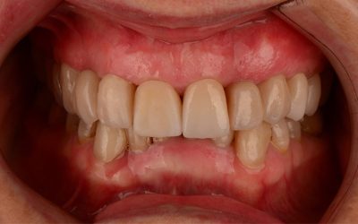 Aesthetic rehabilitation with crowns and zirconia veneers