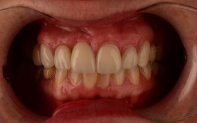 Rehabilitación estética sobre dientes e implantes
