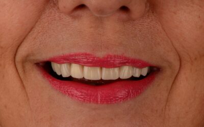 Rehabilitación superior con coronas de zirconio